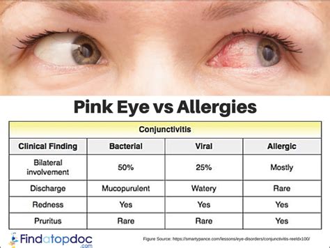 What Causes Allergic Pink Eye