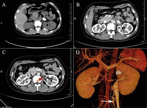 What Causes Blood Clots In The Kidneys