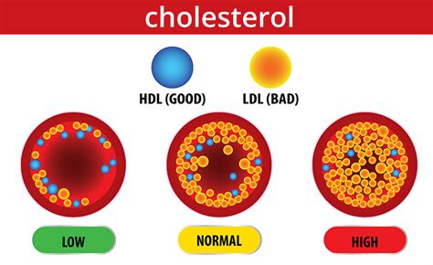 What Causes High Cholesterol Nz